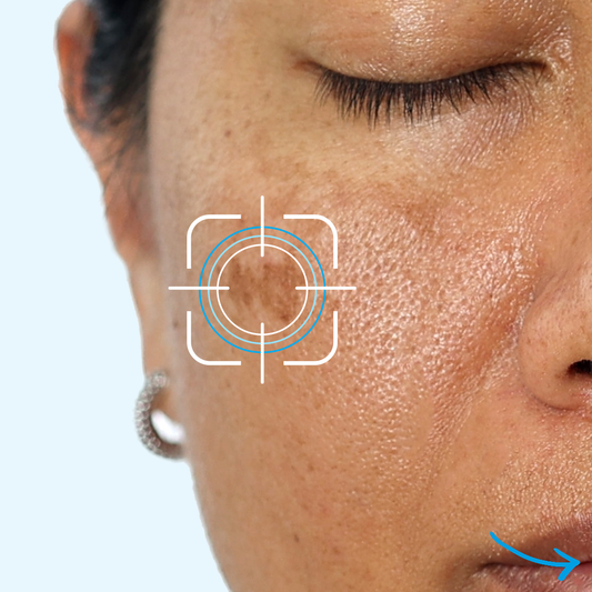 Neotone Sensitive (for Melasma) + Radiance Spf50 bundle